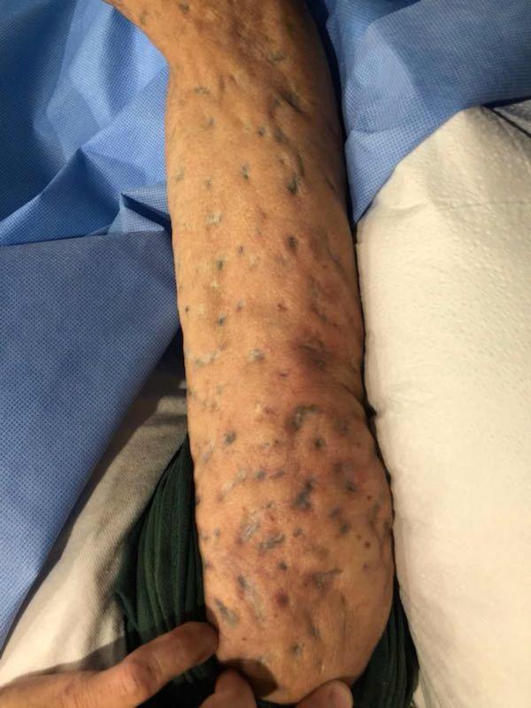 Needle scars in an IV drug user who used for 30 years