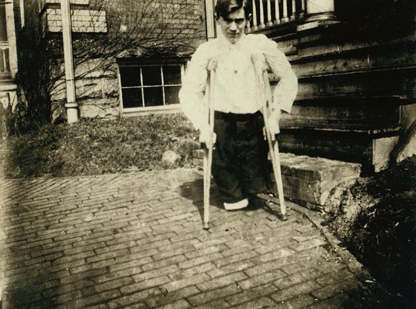 “Frank P……., Whose Legs Were Cut Off By A Motor Car In A Coal Mine In West Virginia When He Was 14 Years 10 Months Of Age.

Location: Monongah, West Virginia”