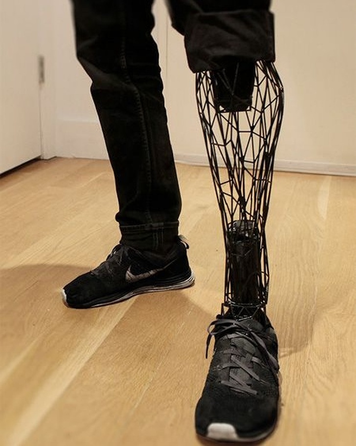 A 3D-printed exo-prosthetic leg