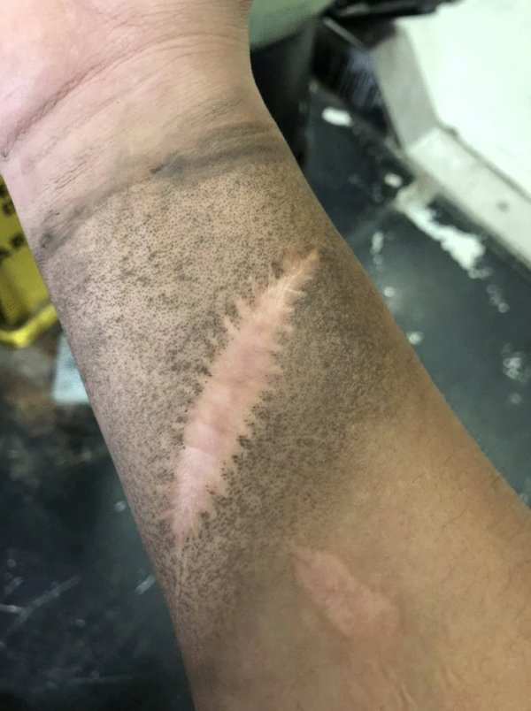 Dirt collects everywhere on thus guy’s arm except for his scar.