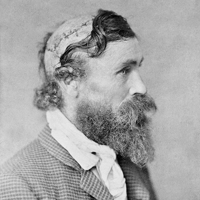 Robert McGee, scalped as a child by a Sioux Chief. circa 1890