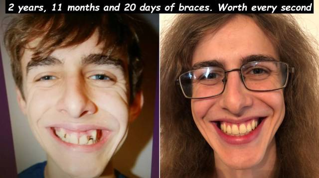 2 years, 11 months and 20 days of braces. Worth every second