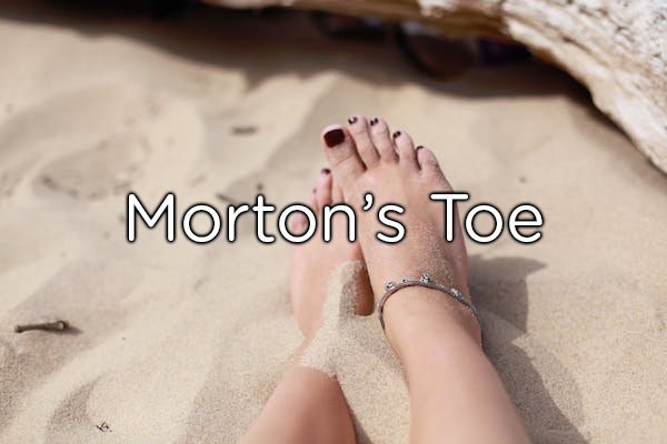 regular feet - Morton's Toe