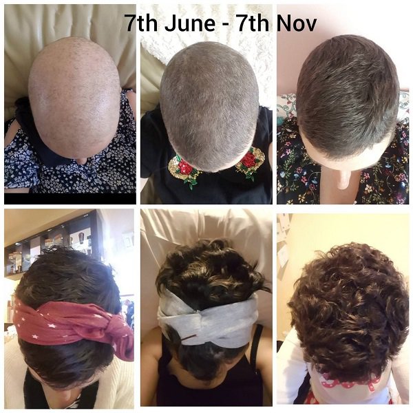 “My wife (32), 5 months after finishing her harshest rounds of chemotherapy”