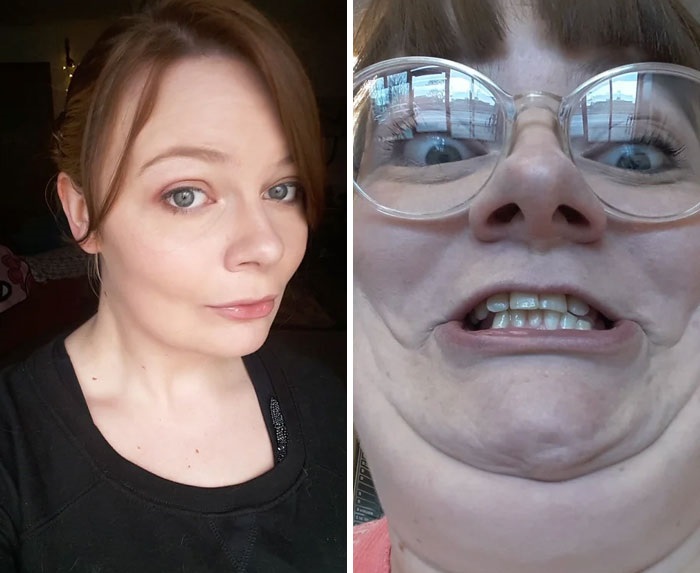 before and after pics - jaw