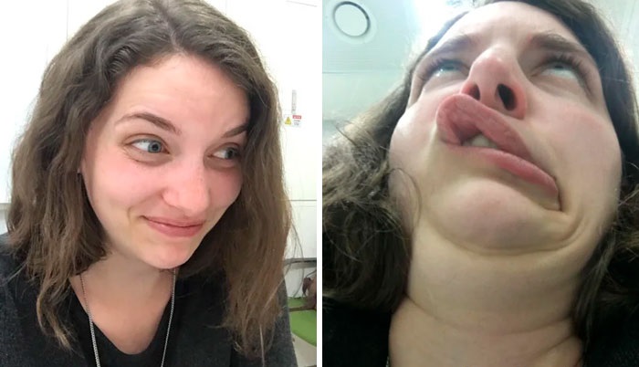 before and after pics - lip - O