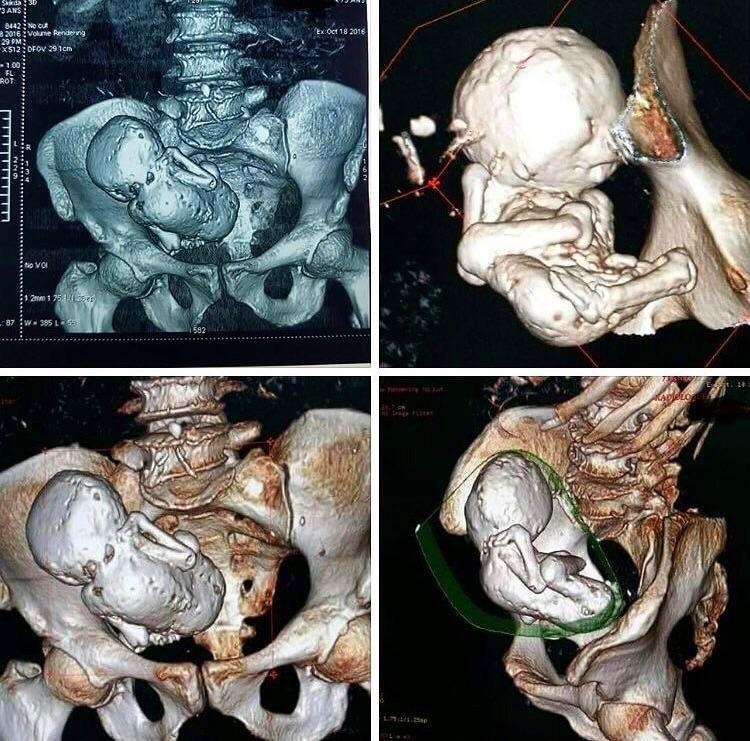 A woman carried this calcified fetus for 30 years
