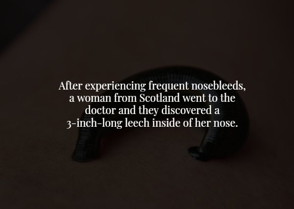 wtf facts - photo caption - After experiencing frequent nosebleeds, a woman from Scotland went to the doctor and they discovered a 3inchlong leech inside of her nose.