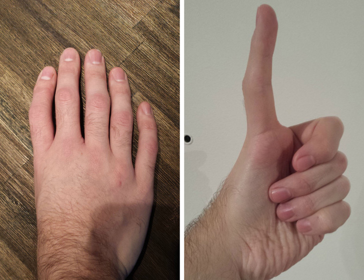 Triphalangeal thumbs have extra bones, making them resemble the other fingers.