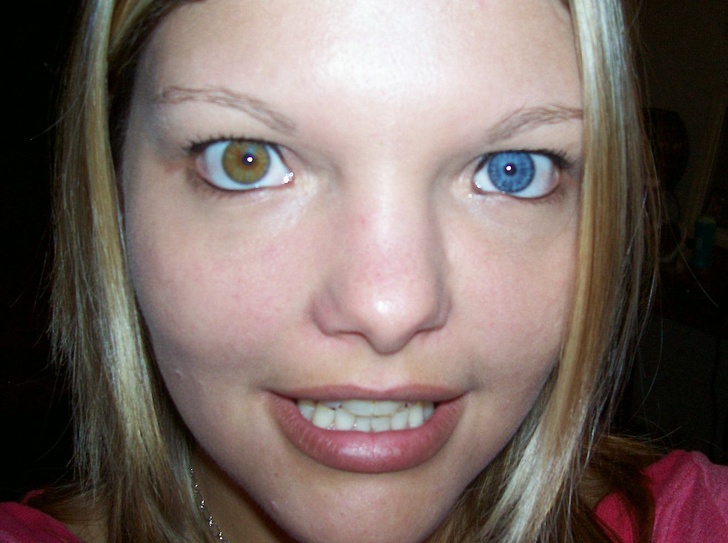 Heterochromia can cause people to have different colored eyes.