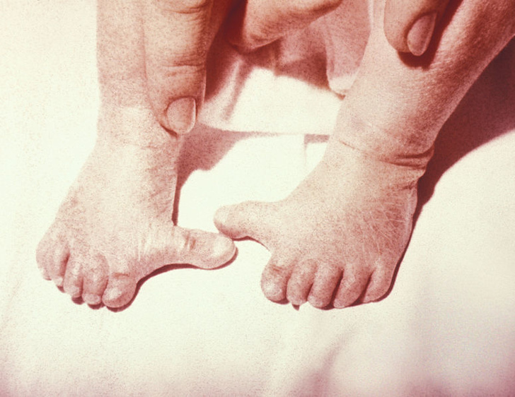 The polydactyly condition causes some people to have more toes than usual.