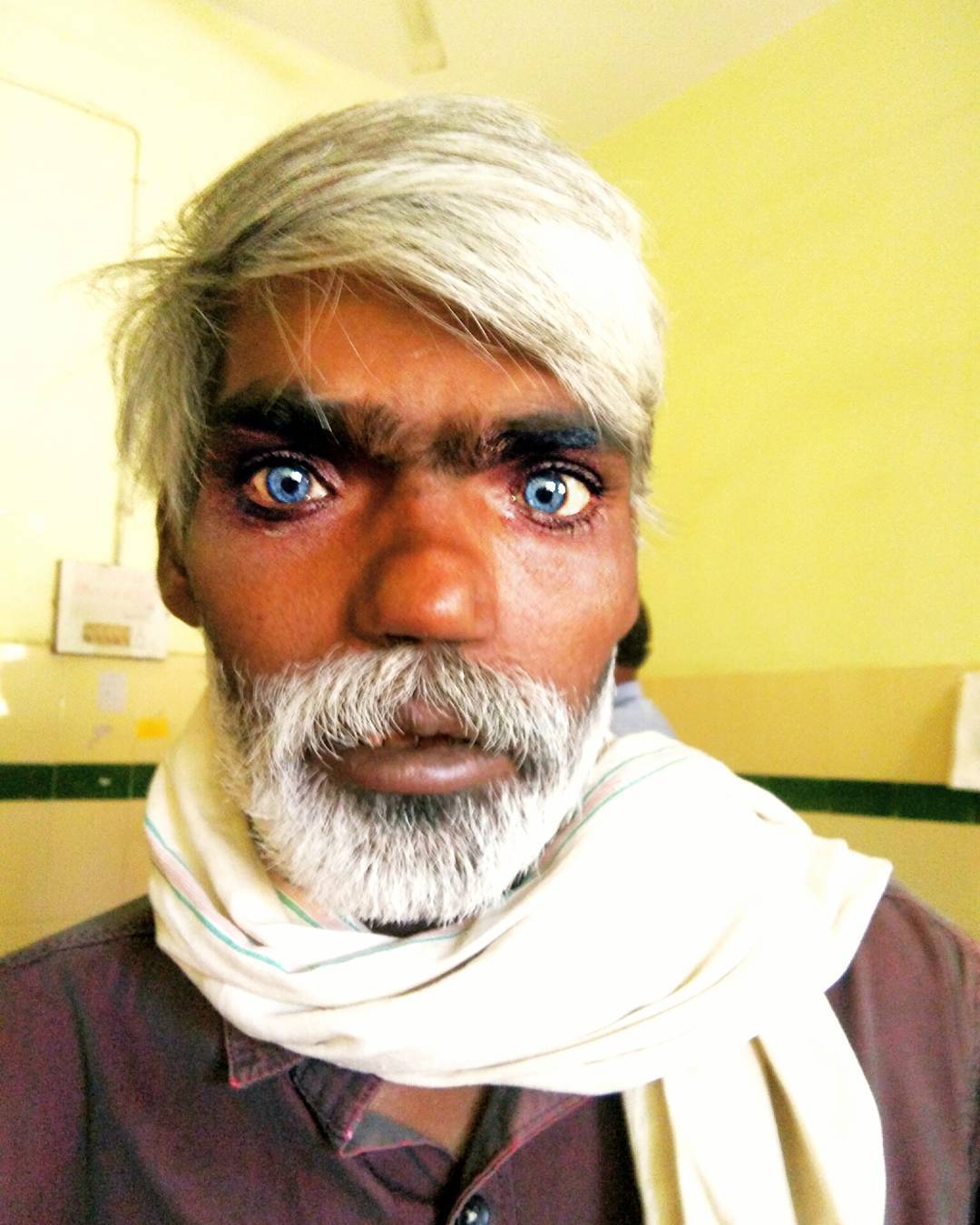 Waardenburg syndrome can cause brilliantly blue eyes and white hair.