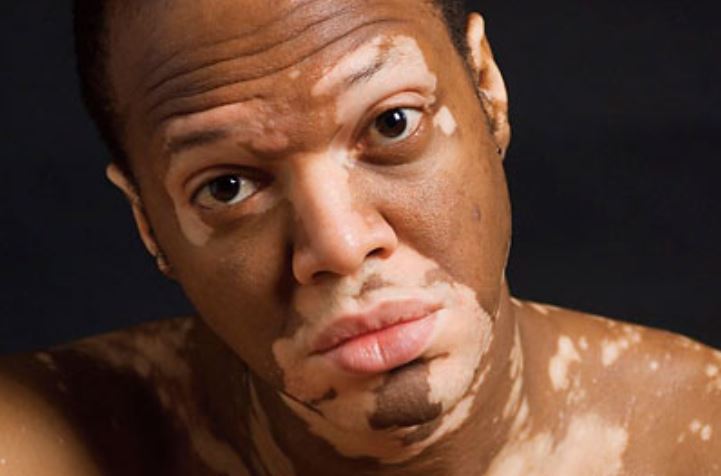 Vitiligo can cause people to lose pigment in their skin.