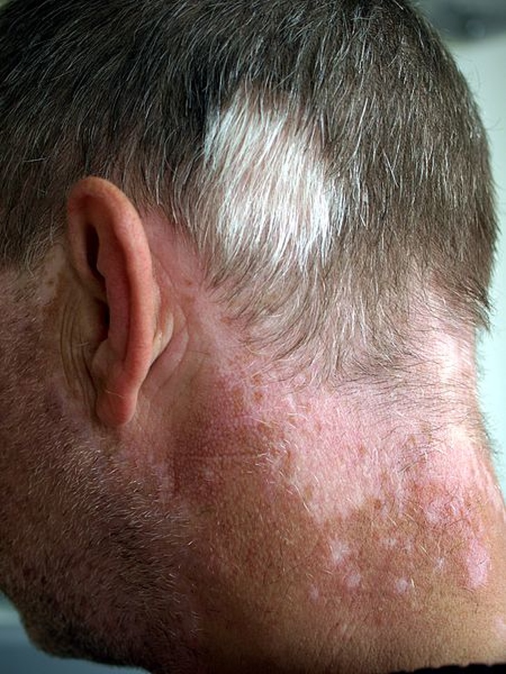 Poliosis can cause a white mark in the hair, in addition to changes in skin color.