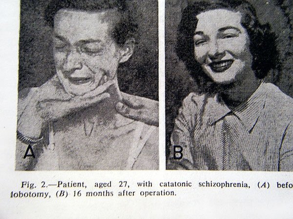 20 Old Photos Showing People Before And After Lobotomies