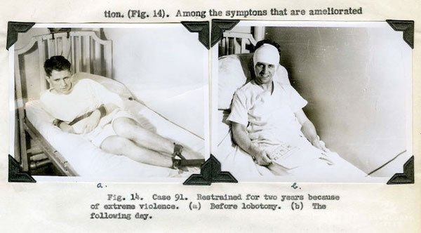 20 Old Photos Showing People Before And After Lobotomies