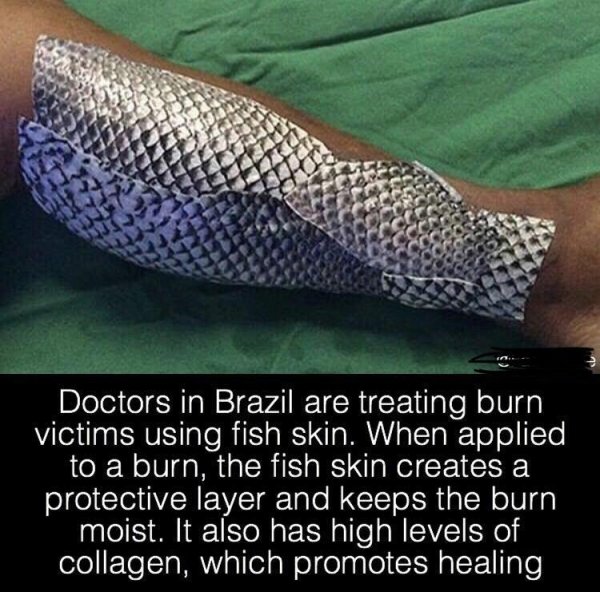 arm - Doctors in Brazil are treating burn victims using fish skin. When applied to a burn, the fish skin creates a protective layer and keeps the burn moist. It also has high levels of collagen, which promotes healing