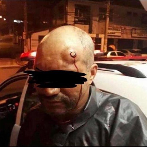 Man Survives Gunshot to the head, Bullet stopped at the bone