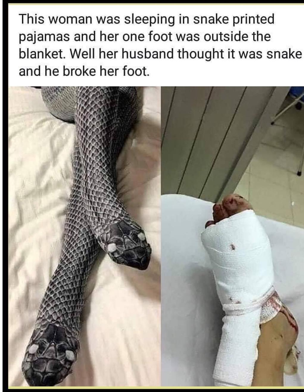 snake pajamas meme - This woman was sleeping in snake printed pajamas and her one foot was outside the blanket. Well her husband thought it was snake and he broke her foot. She On