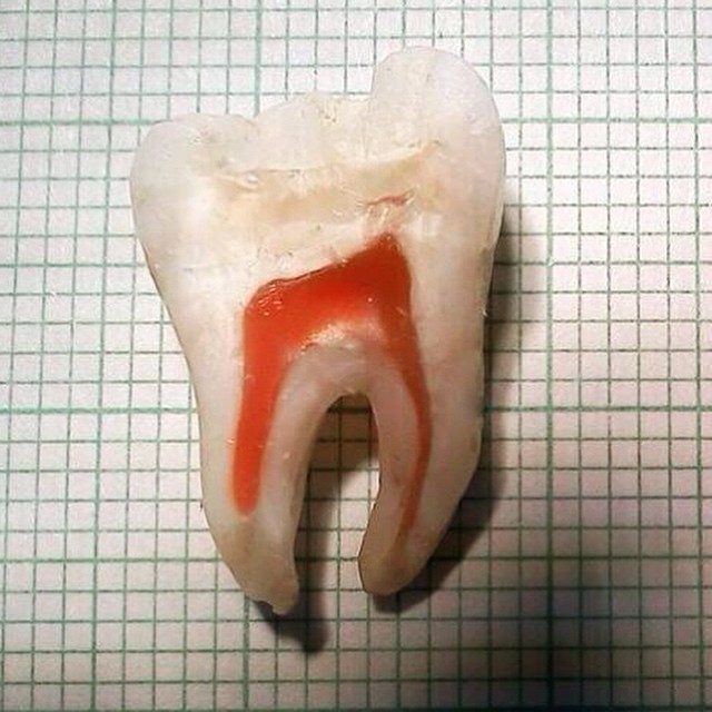 tooth cut in half