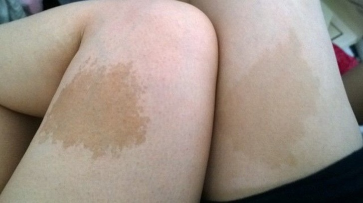 “When I met my wife, it turned out we had similar looking birthmarks on our thighs.”