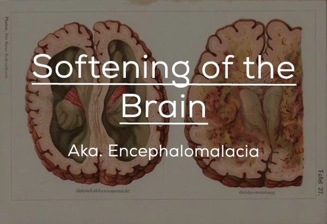 jaw - Softening of the Brain Aka. Encephalomalacia Tafel 27. dutos Cikama .
