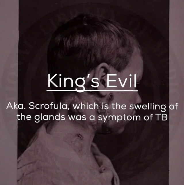 scrofula definition - King's Evil Aka. Scrofula, which is the swelling of the glands was a symptom of Tb