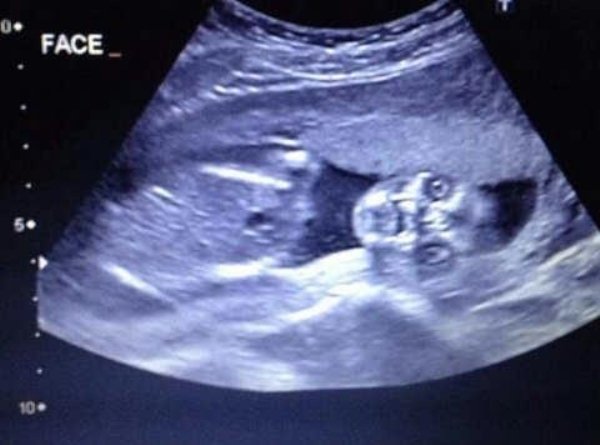 disturbing baby chilling in womb - Face 100