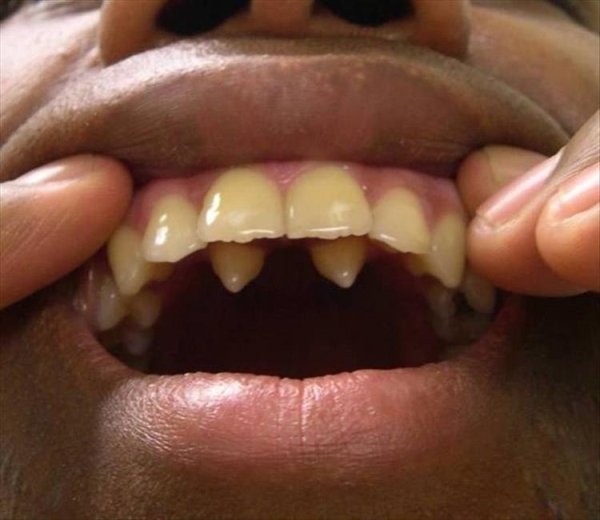 disturbing supernumerary teeth