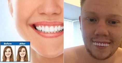 can you get veneers online - Before After Mission