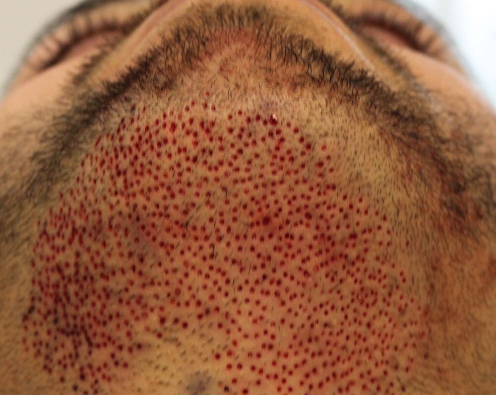 beard transplant trypophobia