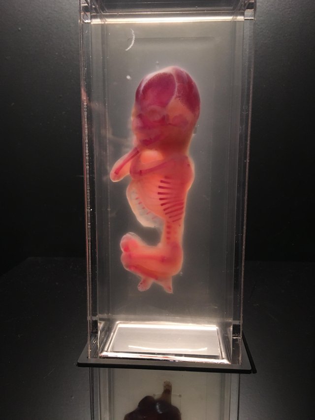 A baby that died before birth