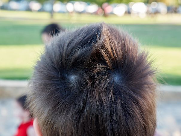 symmetrical hair whorls