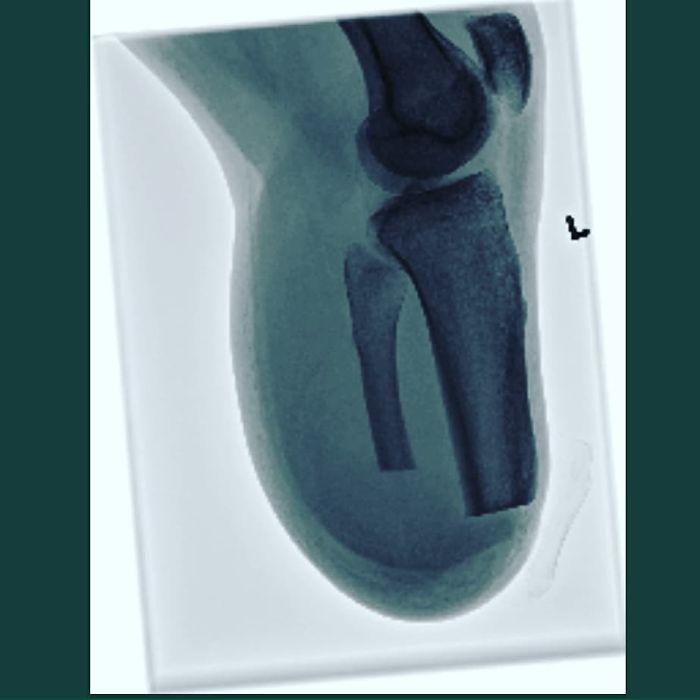 An X-ray of an amputated leg