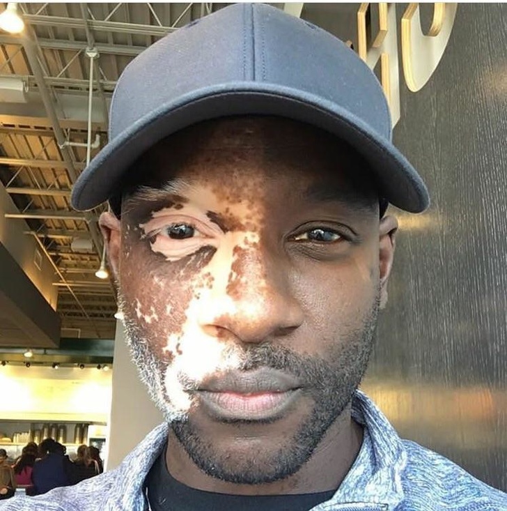 Vitiligo affecting one side of this man’s face.
