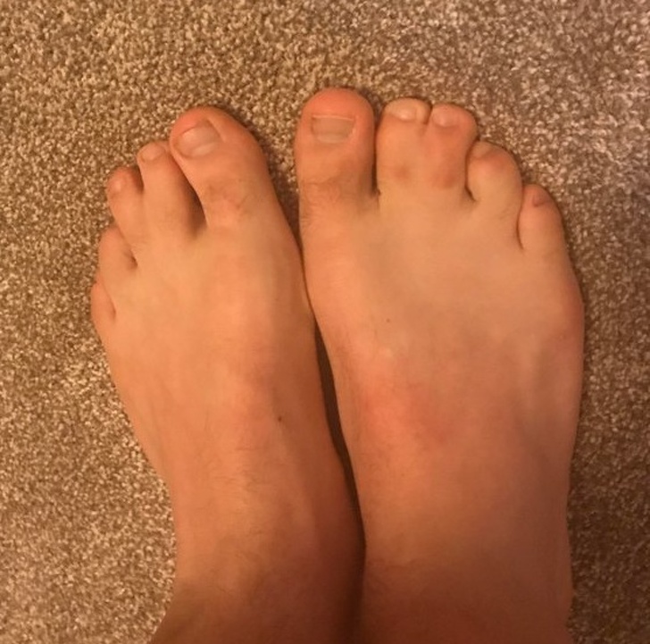 Two toes fused together.