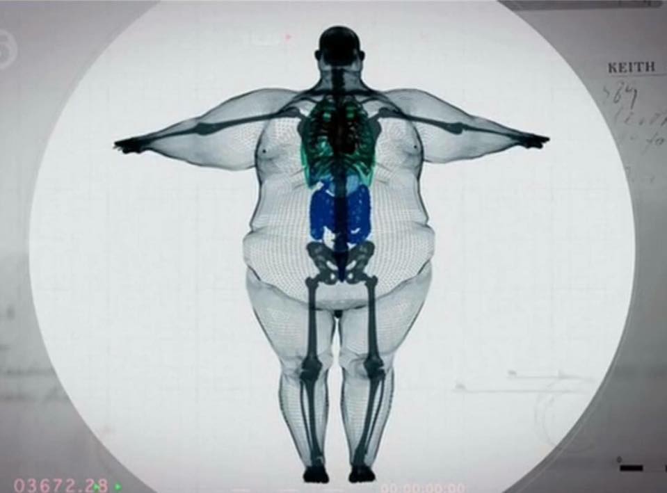 700 pound man x ray - Keith O3672.28.
