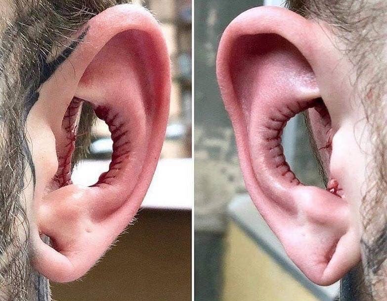 People are now getting the inside of their ears removed in a new body modification trend. The procedure is called a conch removal