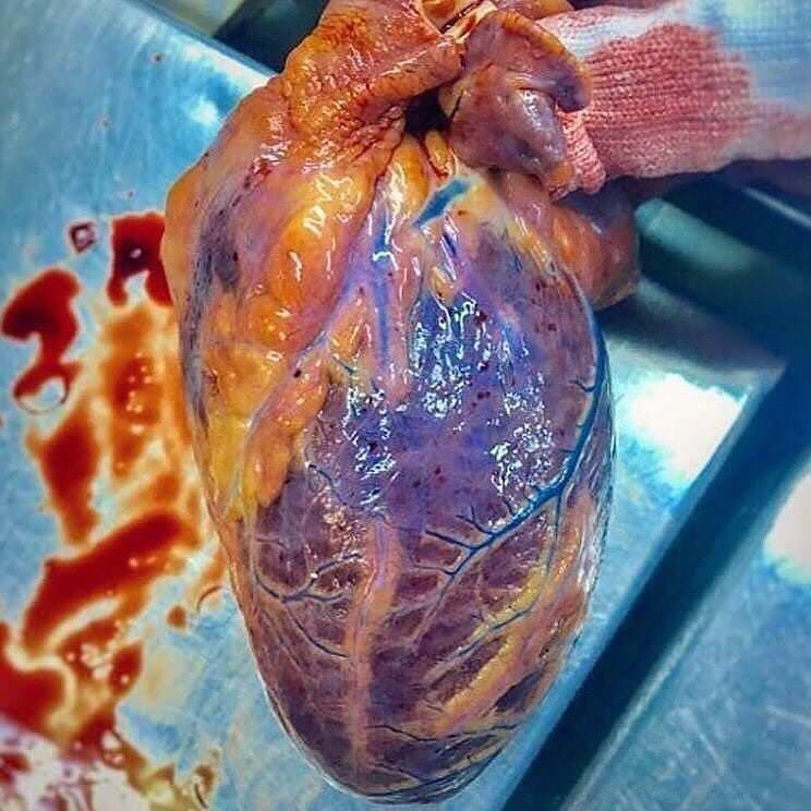 The heart of a person who committed suicide via hanging.