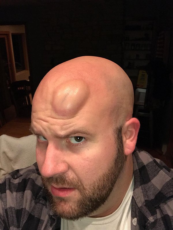 Guy with a massive welt on his head