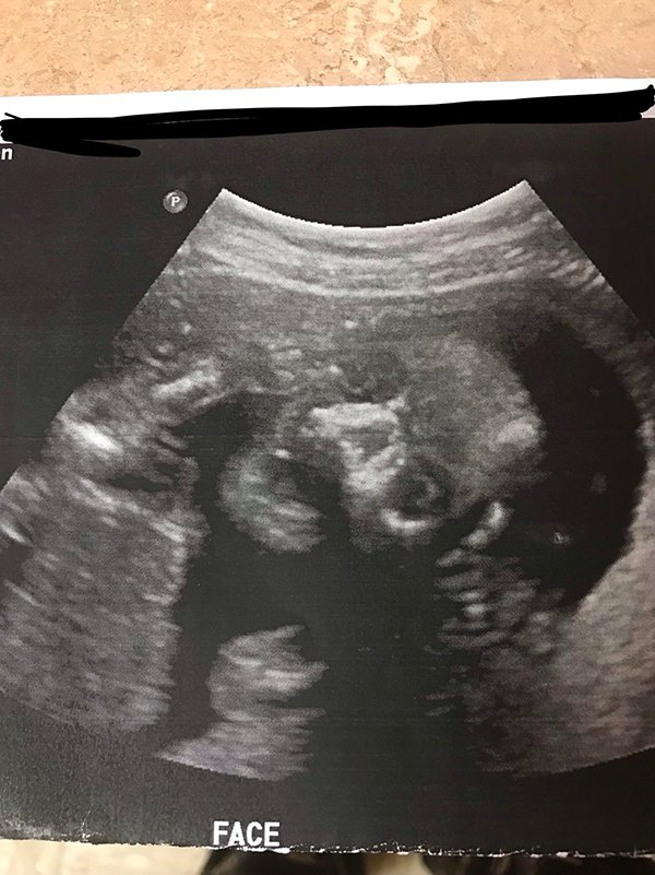 Sonogram with a scary baby face