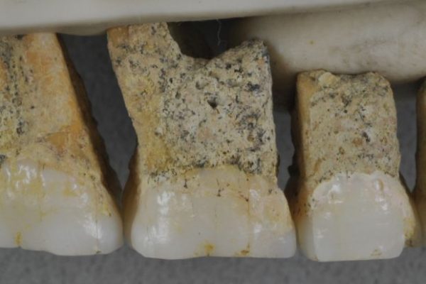 Teeth of a 50,000 year old human.