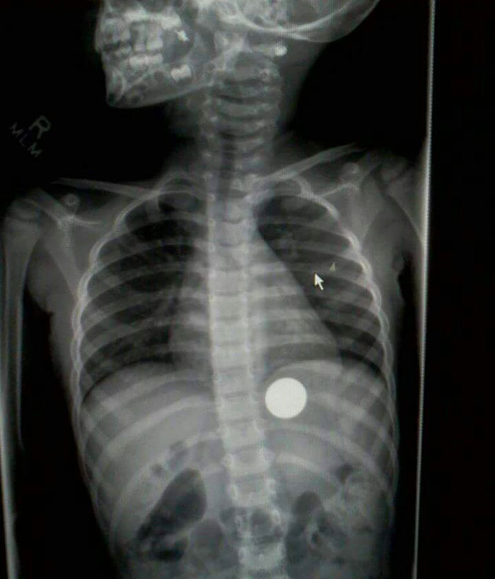 She swallowed a quarter.