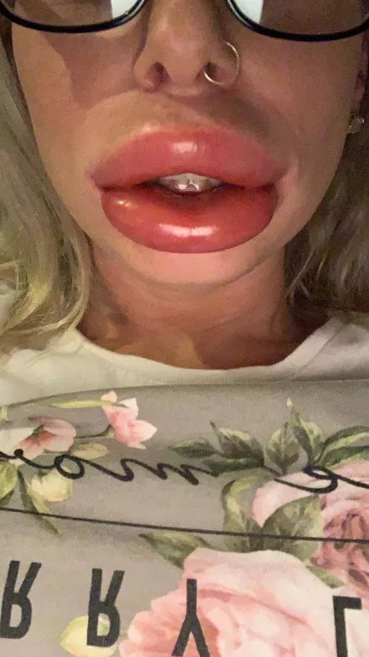 This is why you don't use cheap lip filler. - Facepalm ...
