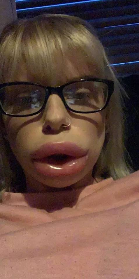 This is why you don't use cheap lip filler.