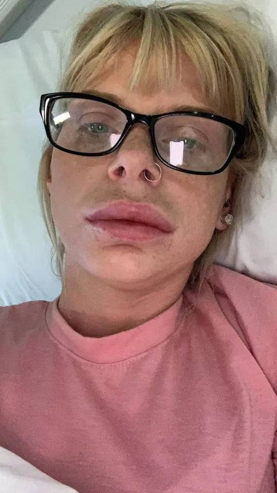 This is why you don't use cheap lip filler.