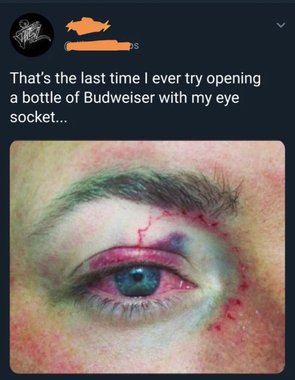 open beer with eye - That's the last time I ever try opening a bottle of Budweiser with my eye socket...
