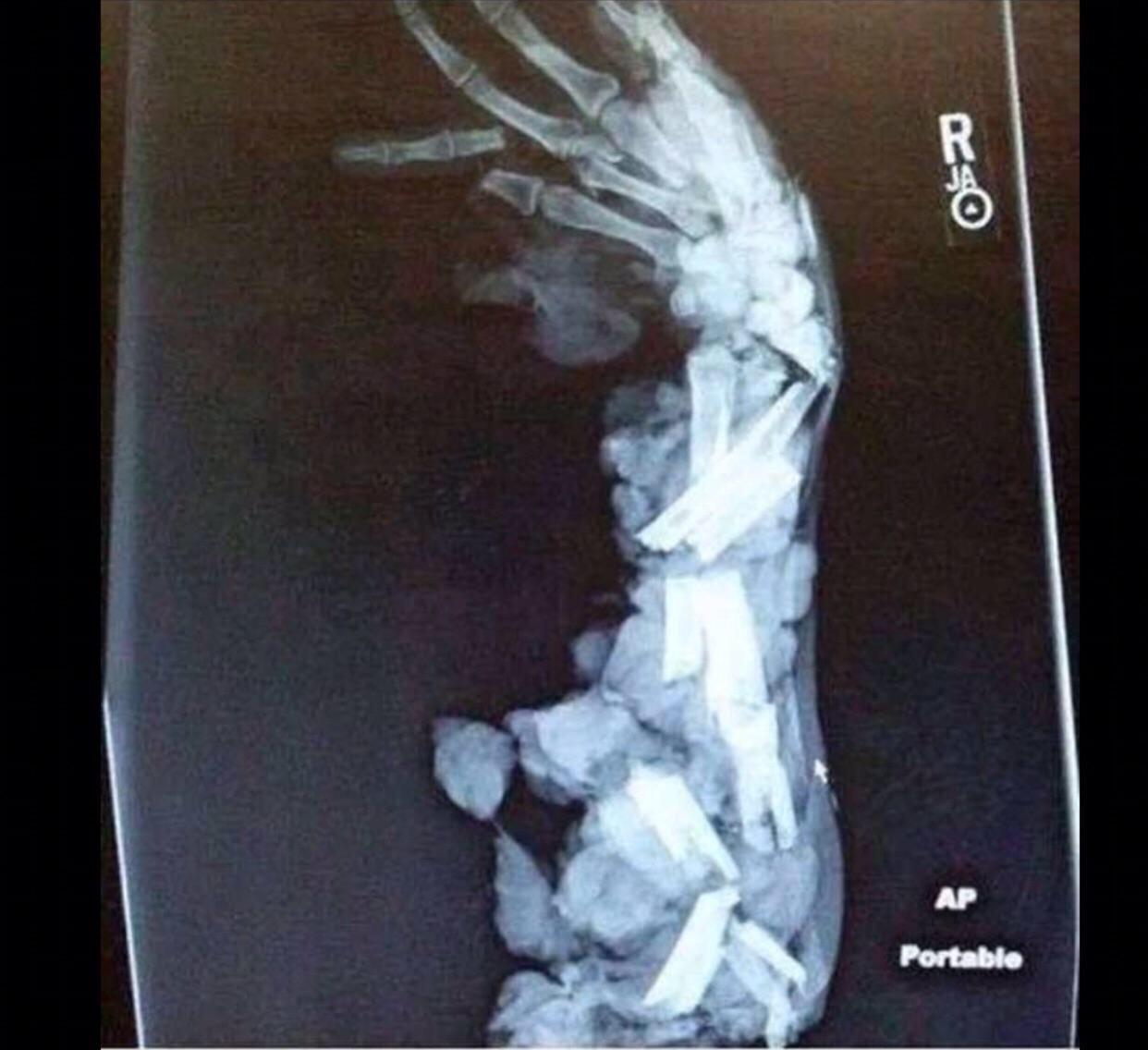 X-ray of a crushed arm.
