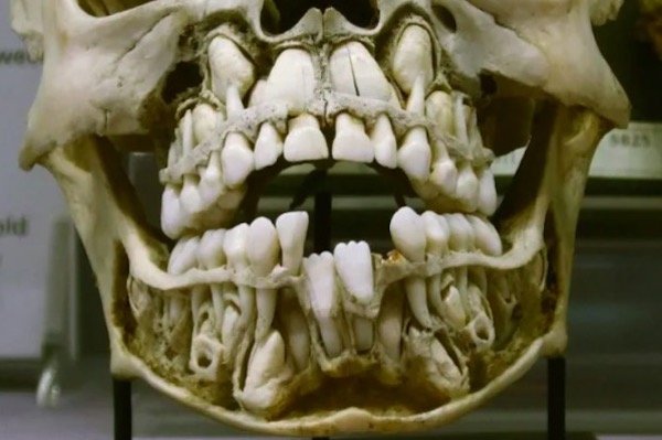 Adult teeth in toddlers are right under their eyes.