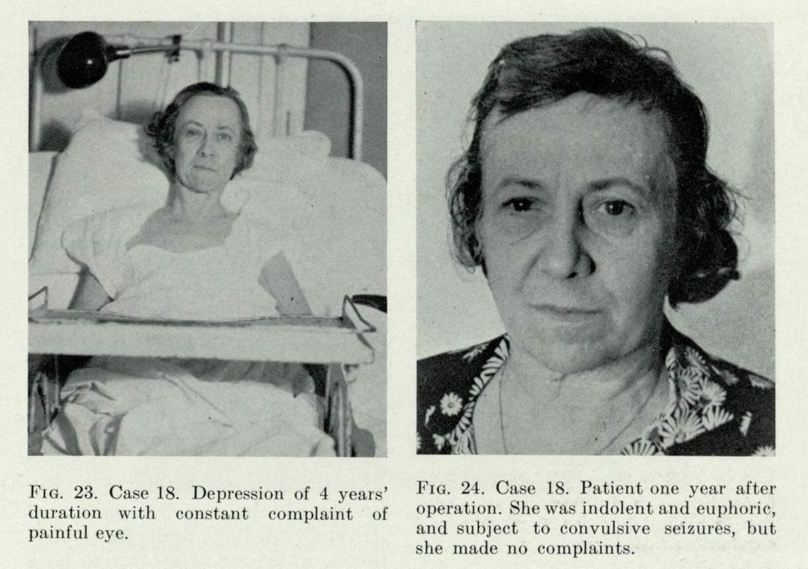 A lobotomy patient one year after her operation.